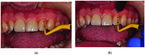 gingival thickness ultrasound